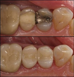 safe mercury amalgam removal technique