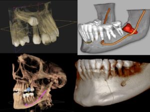 all on 4 implant sedation