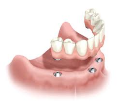 tooth implant sedation