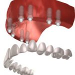 full mouth dental implants