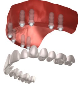 fulll mouth individual implants