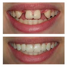 dental implants before and after