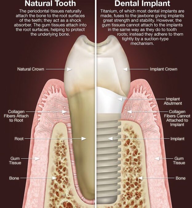 Everything to Know About Dental Implants and Permanent Tooth Replacement
