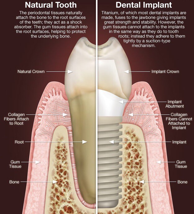 ¿Cómo se sustituye un implante dental por un diente