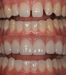 cosmetic sleep dentistry porcelain crowns