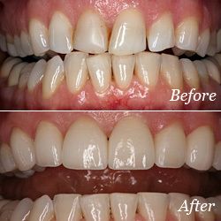 cosmetic sedation dentistry before and after pictures