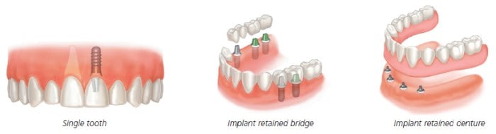 full mouth dental implant options