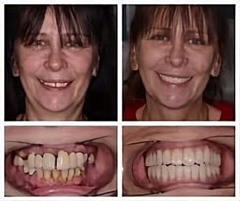 full mouth implants look