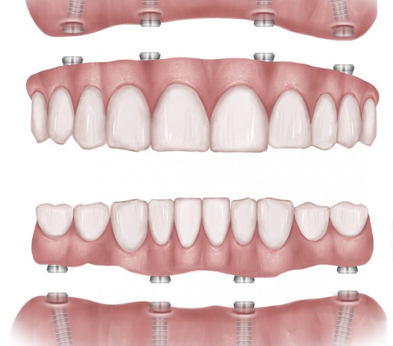 Who Should Get Full Mouth Dental Implants?