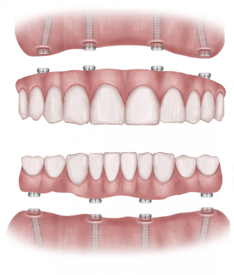 all on 4 permanent implants