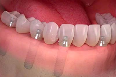 dental implant center