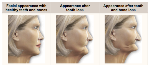 bone loss after losing teeth