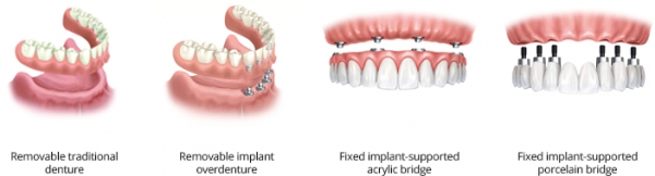 full mouth dental implant costs