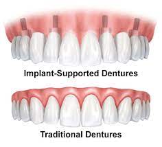 Choosing the Right Teeth: Snap on Dentures or All on 4 Dental Implants