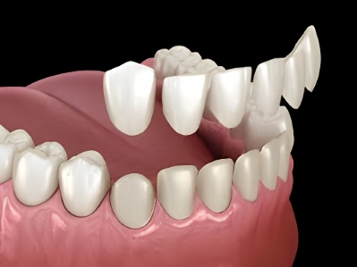 how long teeth veneers last