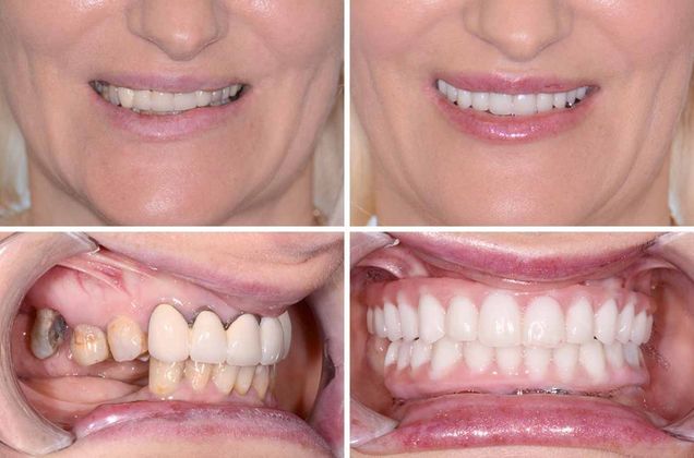 Dental Implants Full Mouth