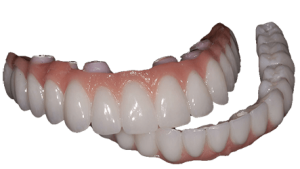 appearance of full mouth implant teeth