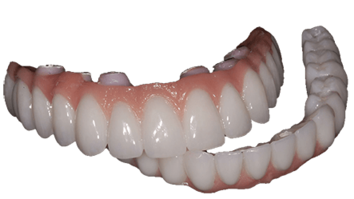 appearance of full mouth implant teeth