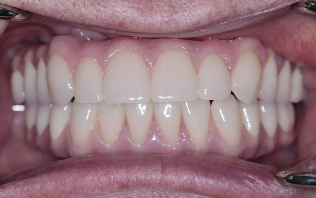 How much is a Full Top Set of Dental Implants?