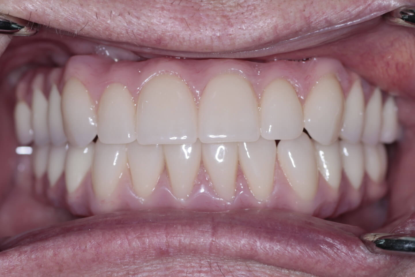 Full Top Set of Dental Implants