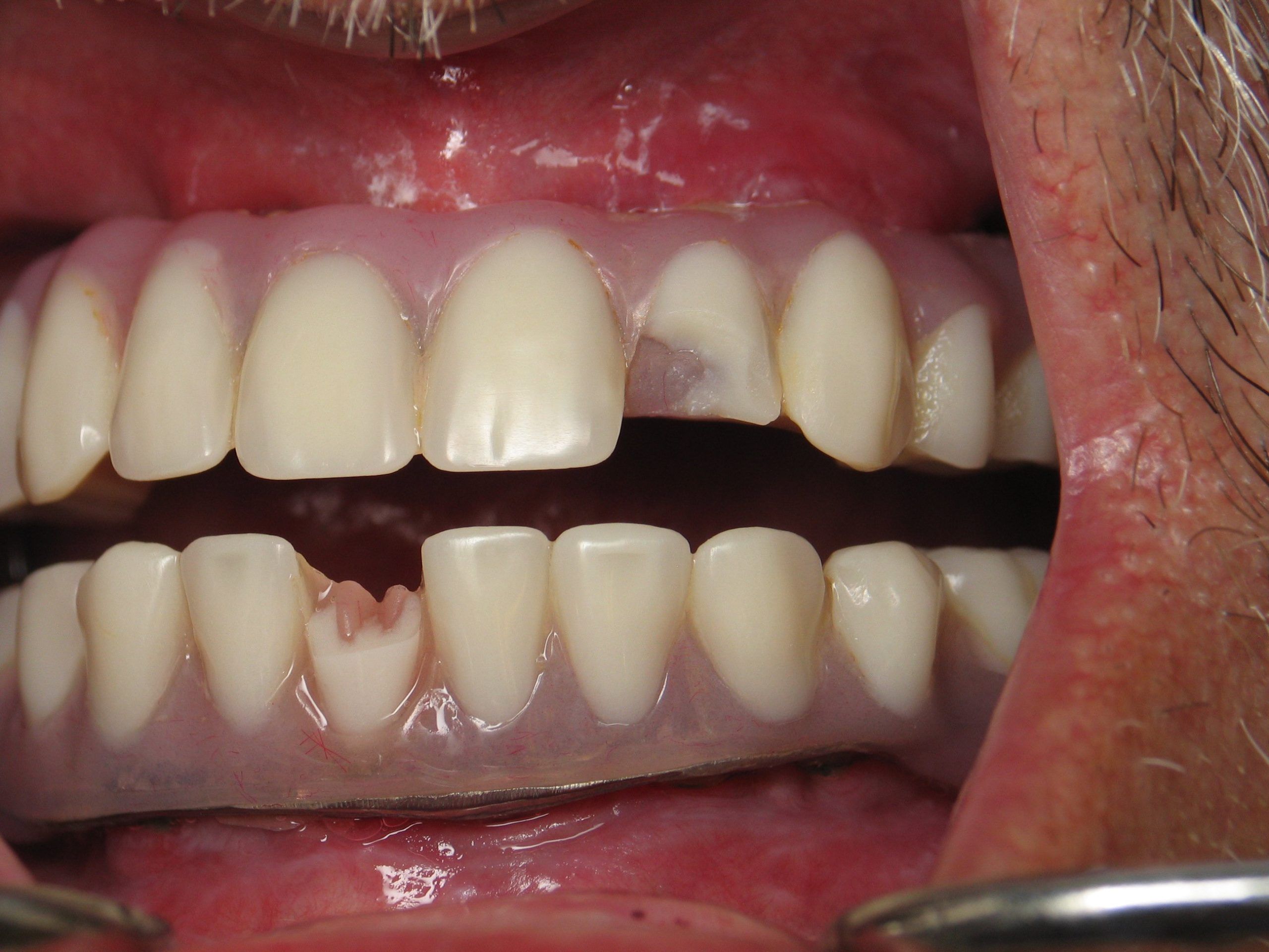 broken acrylic full mouth implants