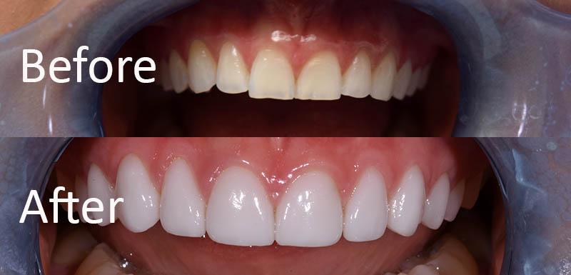 All About Cosmetic Veneers for Teeth?