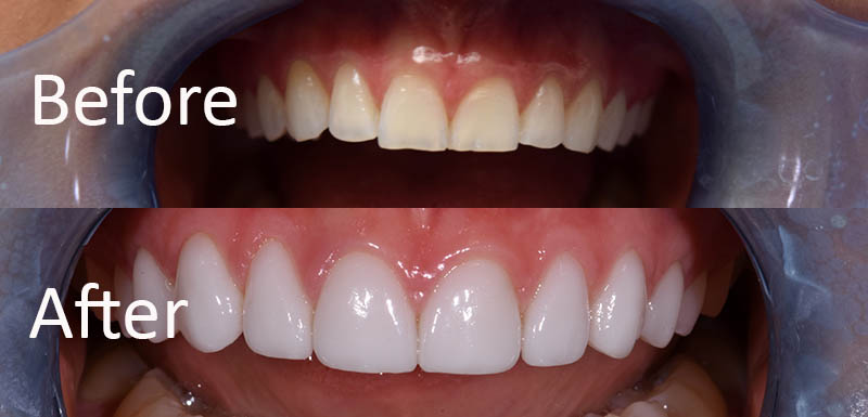 teeth veneers before and after