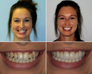 teeth veneers before and after picture