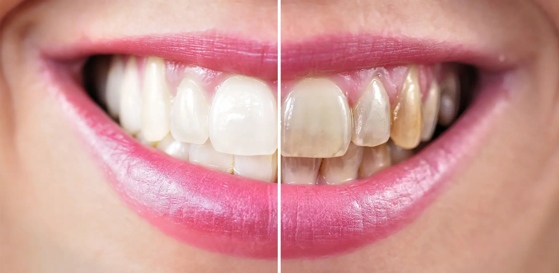 How Much Does Teeth Whitening Cost?