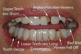 why not to do teeth veneers