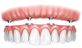 snap-on denture implant