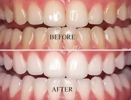 teeth whitening