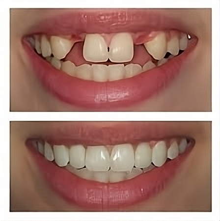 the dental implant process under sedation