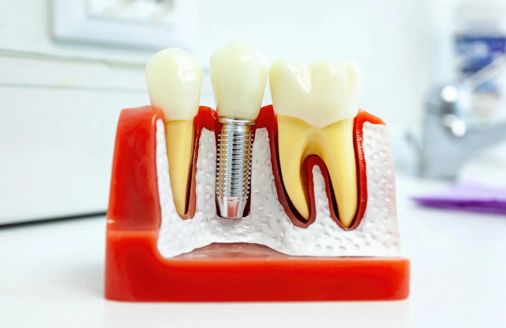 Considering Dental Implants? 5 Signs You’re a Great Candidate