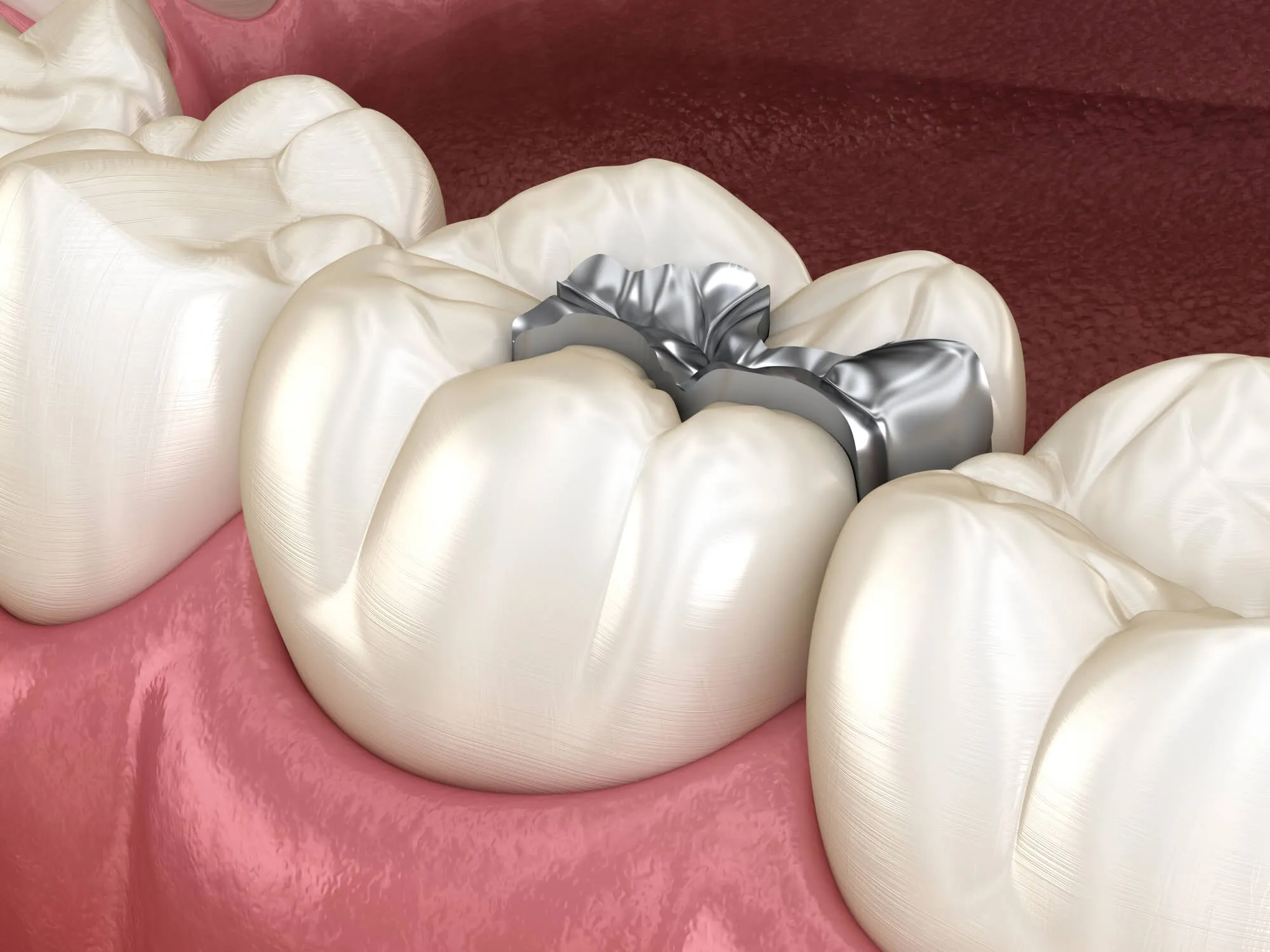 Why Some People Choose to Replace Old Amalgam Fillings