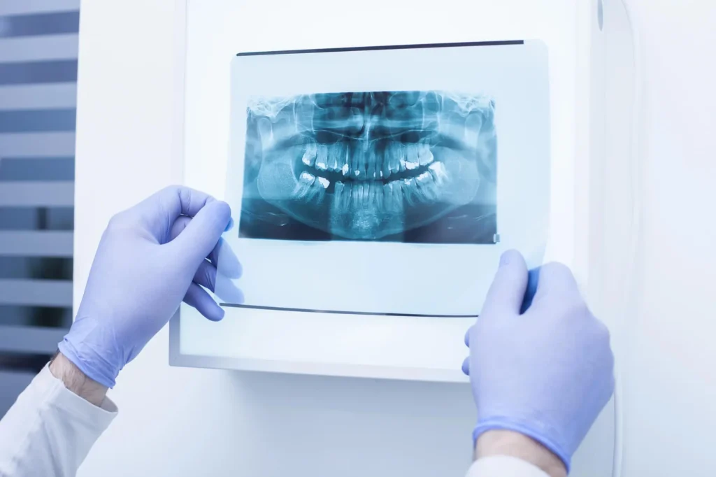 Preparing for Oral Surgery in Laurel