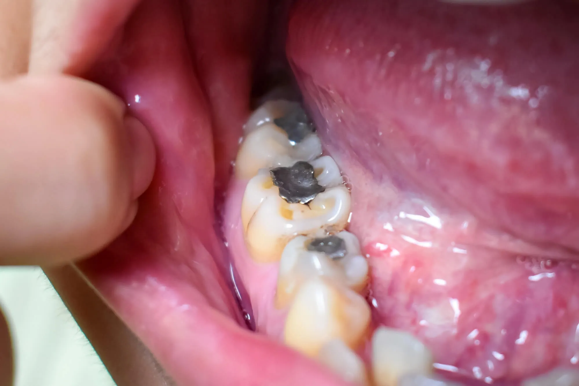 before removing amalgam fillings Montgomery county