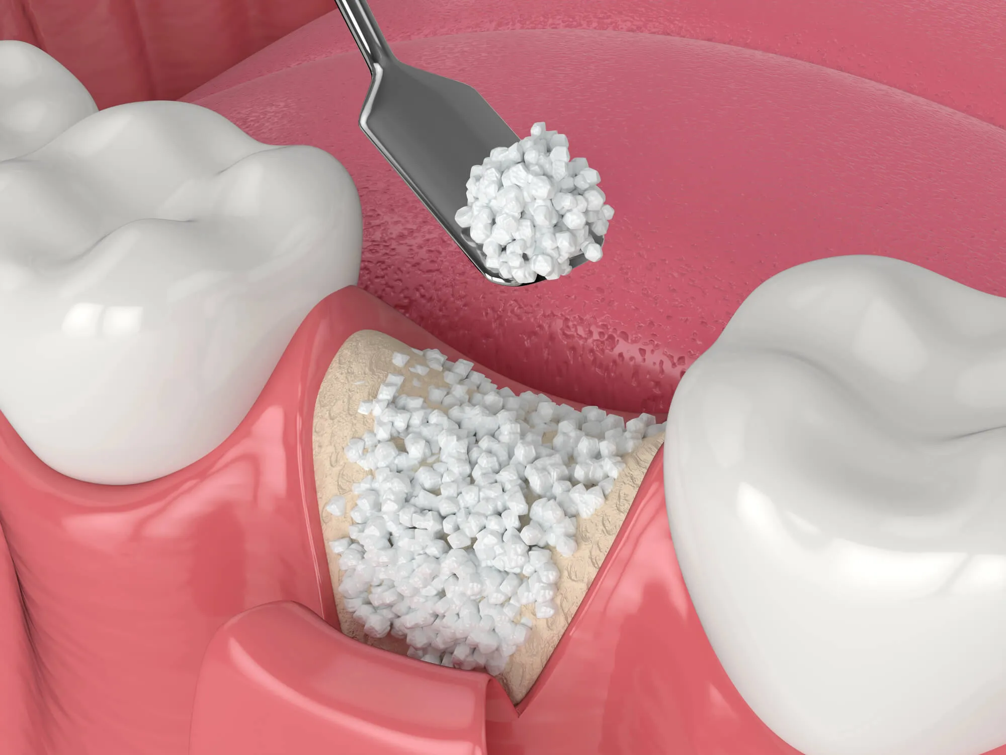 Dental Bone Grafting Explained: Purpose, Process and Healing