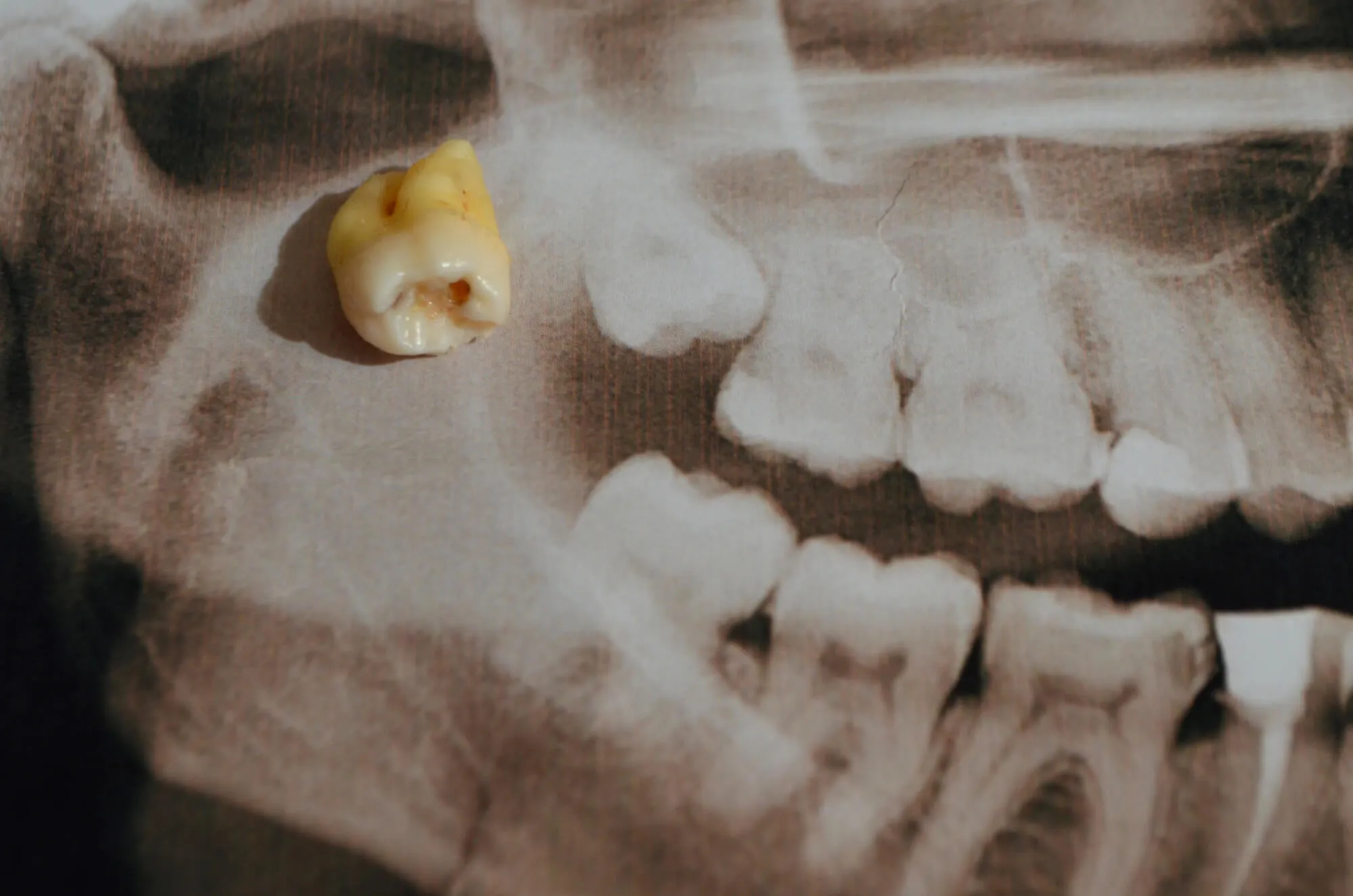 Signs Your Wisdom Teeth Are Starting to Cause Problems