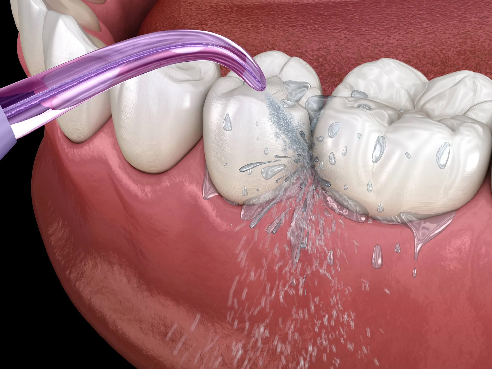 deep teeth cleaning with anesthesia cost