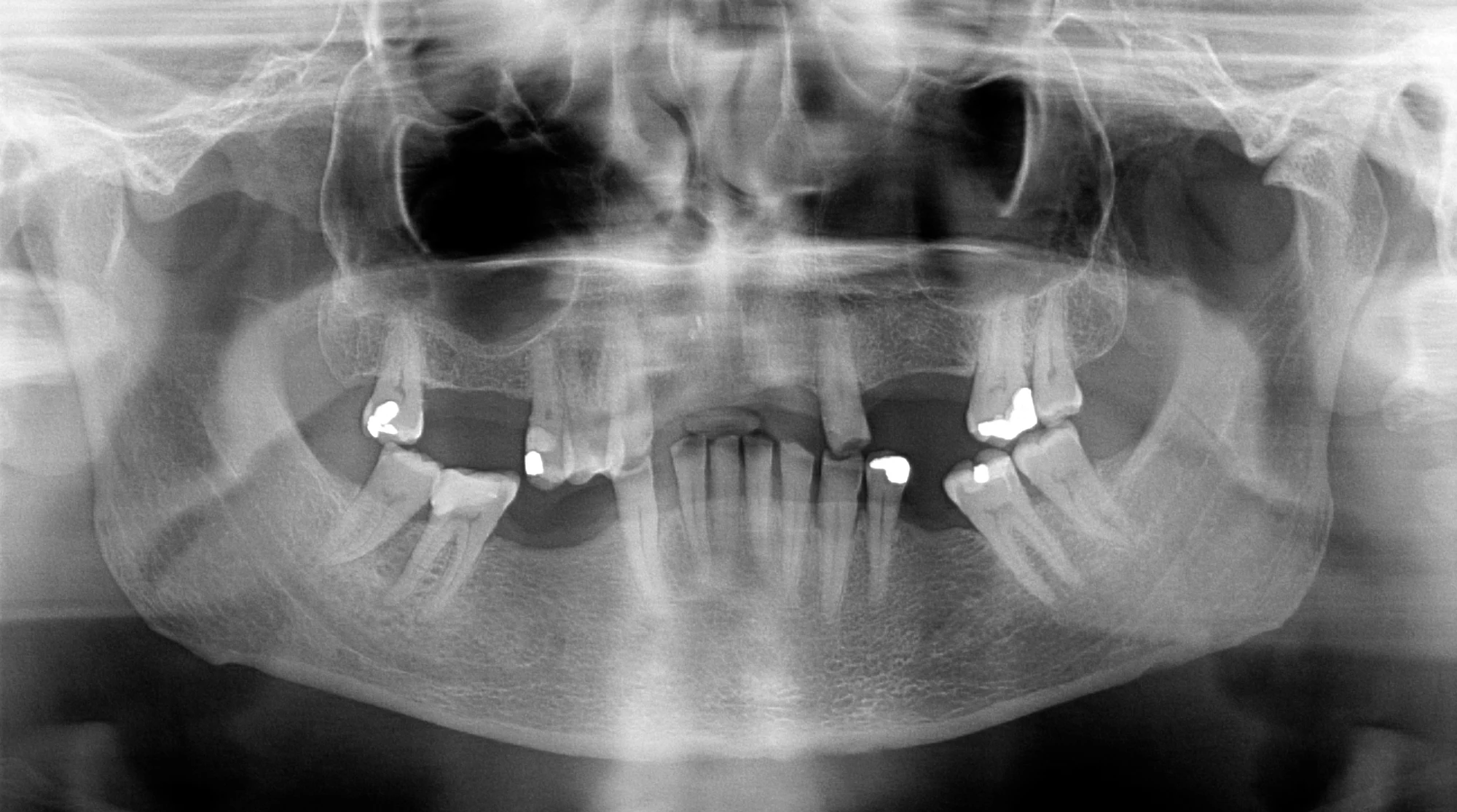 dental x-rays showing damaged teeth