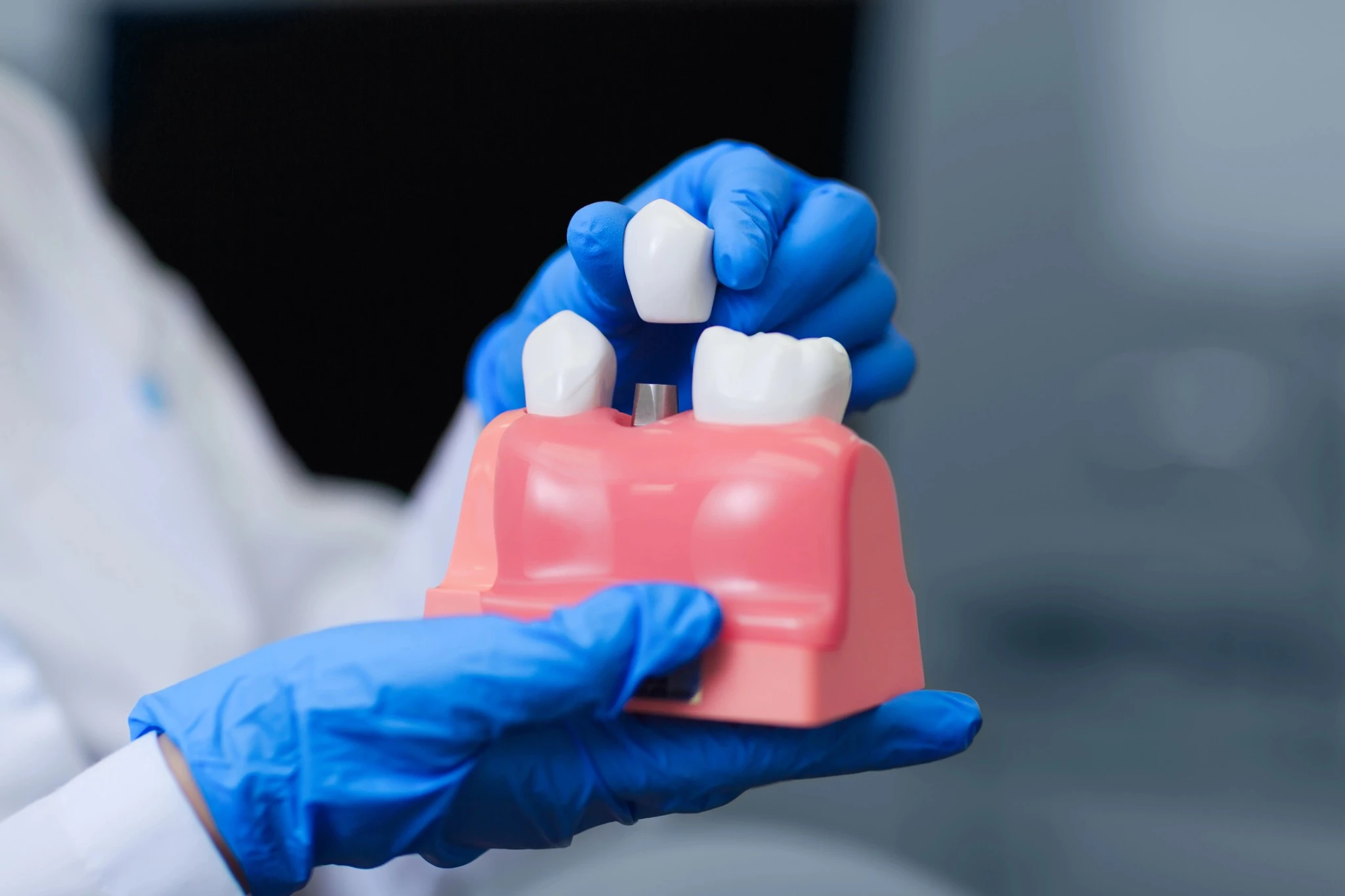 dental-implants-burtonsville-md-implant-model