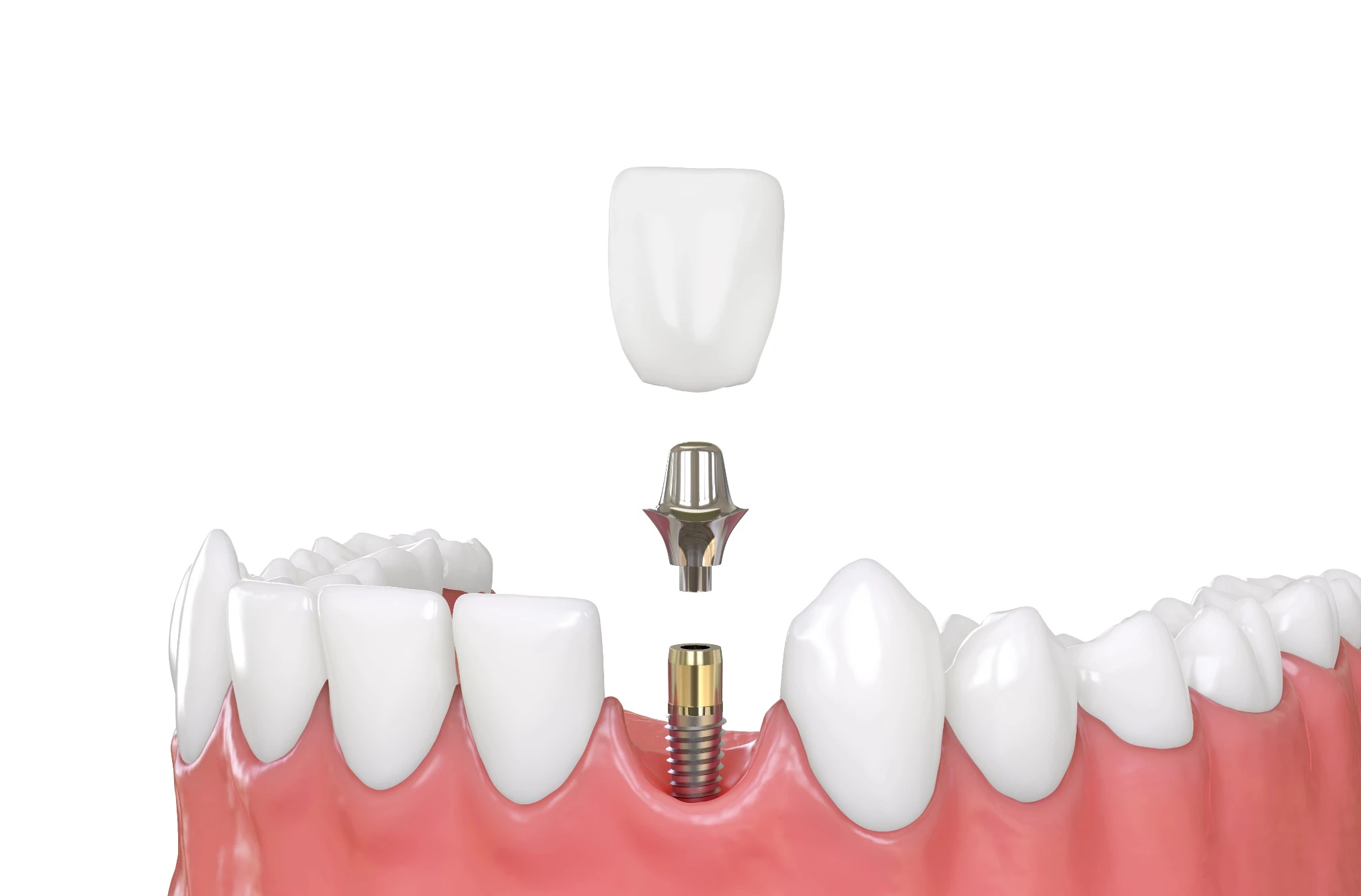 dental-implants-burtonsville-md-implant-restoration