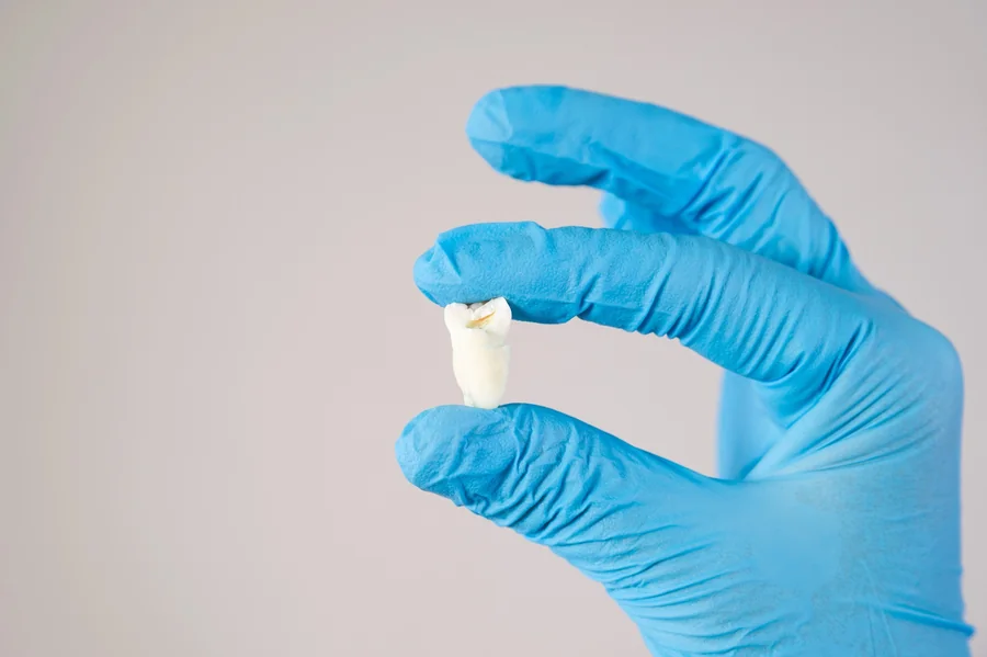 How Long Does It Take to Recover From Wisdom Teeth Extraction?