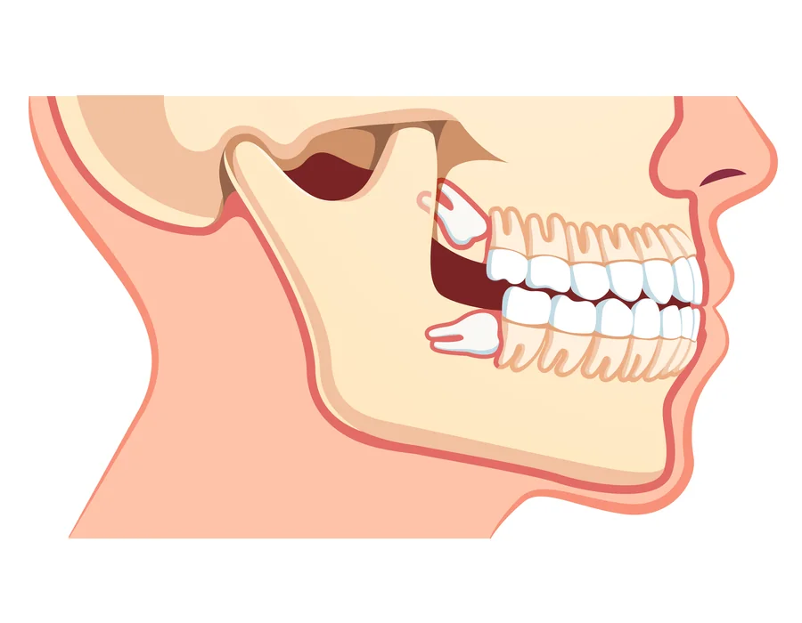 wisdom-teeth-removal-maryland-impacted-wisdom-teeth-diagram