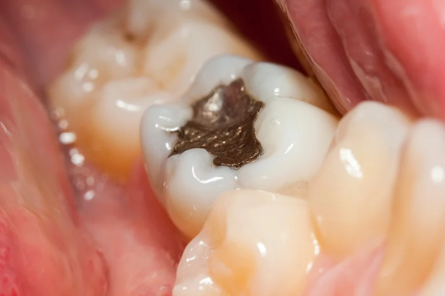 How Dental Professionals Perform Amalgam Filling Removal