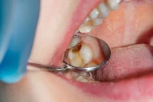 tooth-with-old-amalgam-filling-ready-for-safe-removal-montgomery-county